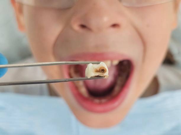 Best Emergency Treatment for Dental Infections or Abscesses in Okawvle, IL